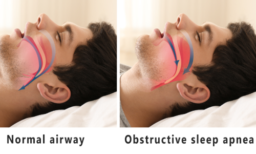 Sleep apnea